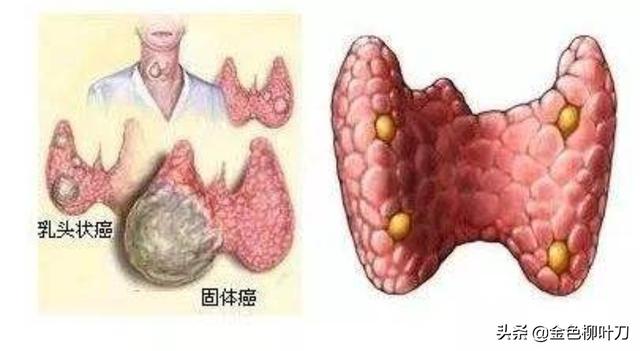 头条问答 - 乳头状甲状腺癌生存率如何?(16个回答)