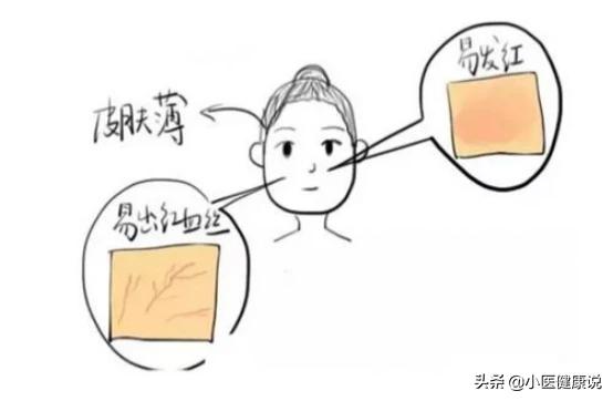脸部有红血丝:脸部有红血丝用什么化妆品 脸部红血丝是什么原因？是病吗？