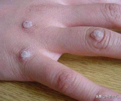 头条问答 - 为什么夫妻双双查出菜花疣,结果竟是宫颈癌病的提示?