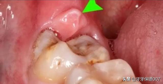 齿诺洗牙笔好用吗:齿诺洗牙笔 牙齿上有污垢如何清理？牙齿如何变白？