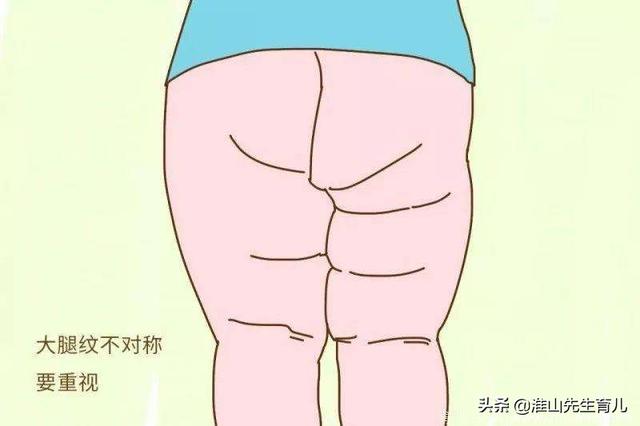 头条问答 - 婴儿皮纹不对称,一定是腿发育有问题吗?正常吗?(18个回答)