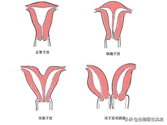 鞍状子宫自然流产两次做手术后不试管可以怀孕吗