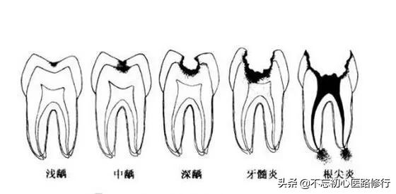 四环素牙是什么:什么牙齿着色现象属于外因性色素牙？