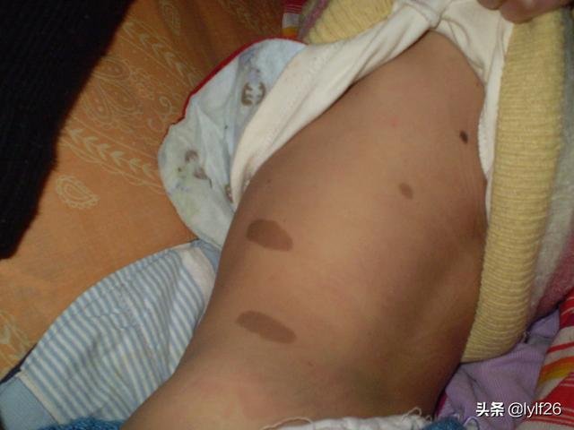 儿童得了神经纤维瘤怎么办