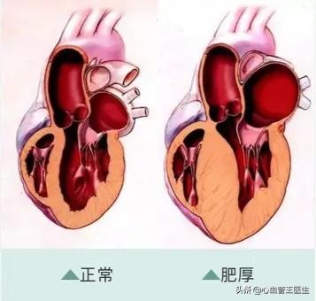 心尖肥厚性心肌病寿命:得了肥厚型心肌病的人还能活多久？