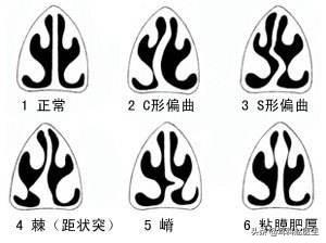 人鼻腔结构图:为什么全球超过10亿人得鼻炎？这到底是一种什么病？