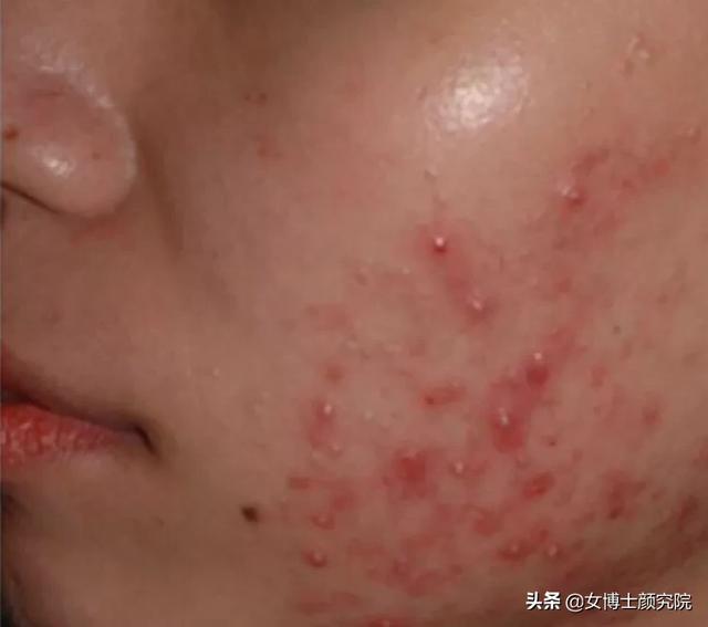 毛囊虫的原因是什么:毛囊虫是什么原因引起的 脸上、背上长了5年的痘痘，这是因为湿气太重吗？