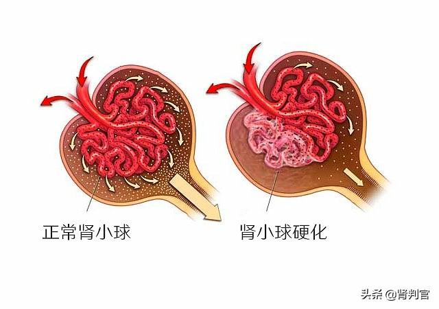 头条问答 - 高血压疾病是如何对肾脏造成损伤的?(5个回答)