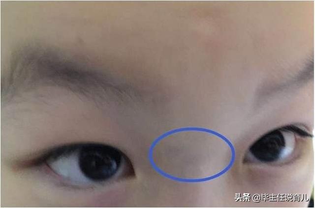 婴幼儿肠胃不适的症状:孩子脾虚积食，看看眼袋就知道！宝宝脾虚积食还有哪些表现？