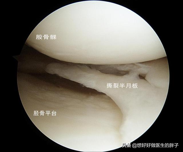 半月板撕裂:右膝关节韧带断裂，半月板撕裂，以后还能做体力活吗？