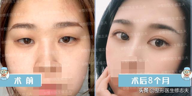 古巨基割双眼皮:长期贴双眼皮贴最后都会走上割双眼皮的路吗