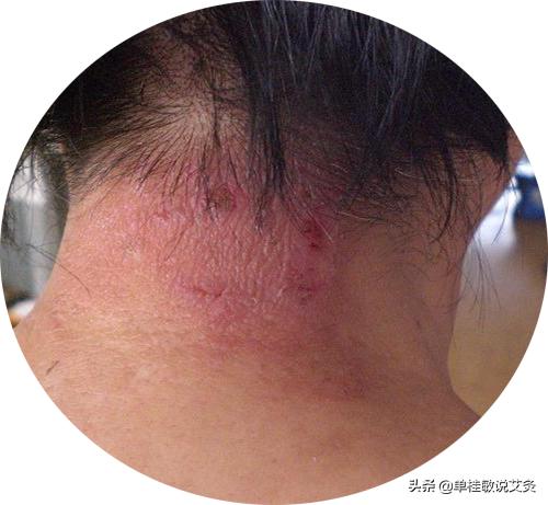 头条问答 - 艾灸后出现非常痒的小疙瘩小水泡,是怎么回事?(1个回答)