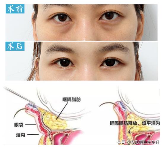 怎样快速去眼袋;怎么消除大眼袋