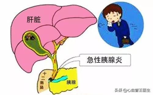 胰腺炎会死人吗，高血脂会引起急性胰腺炎吗会致命吗