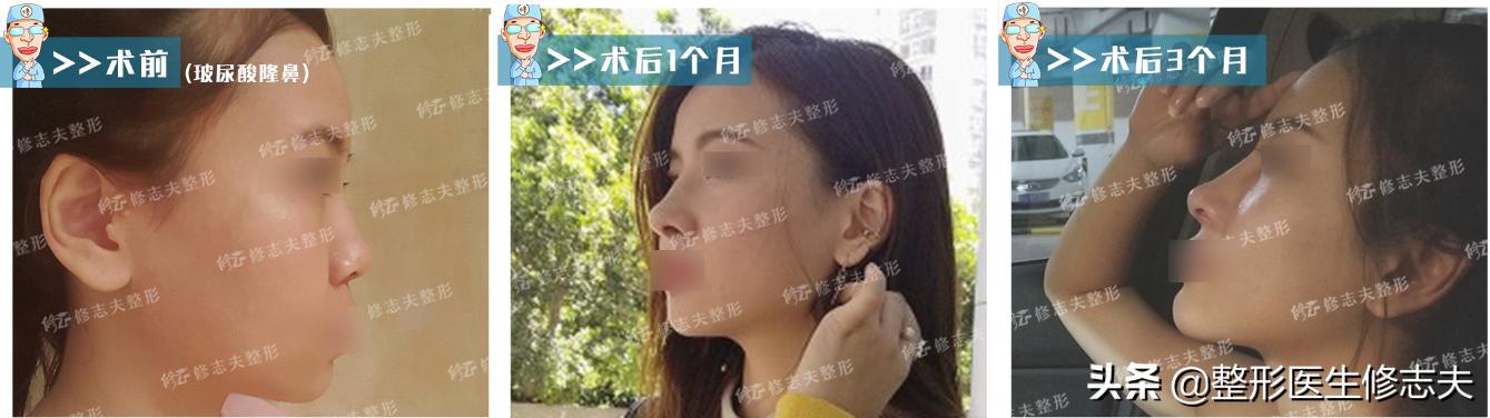 塌鼻梁图片:鼻梁塌、鼻翼宽，塌鼻人如何自救？