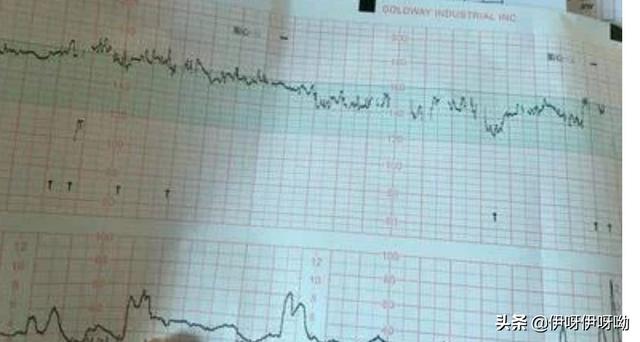 头条问答 胎心率偏低是什么原因 伊呀伊呀呦的回答 0赞