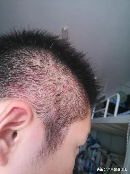 不常见皮肤病症状图片:猪常见皮肤病的症状及图片 头皮里经常长疙瘩，可能有哪些原因？有没有哪些快速消除的办法？