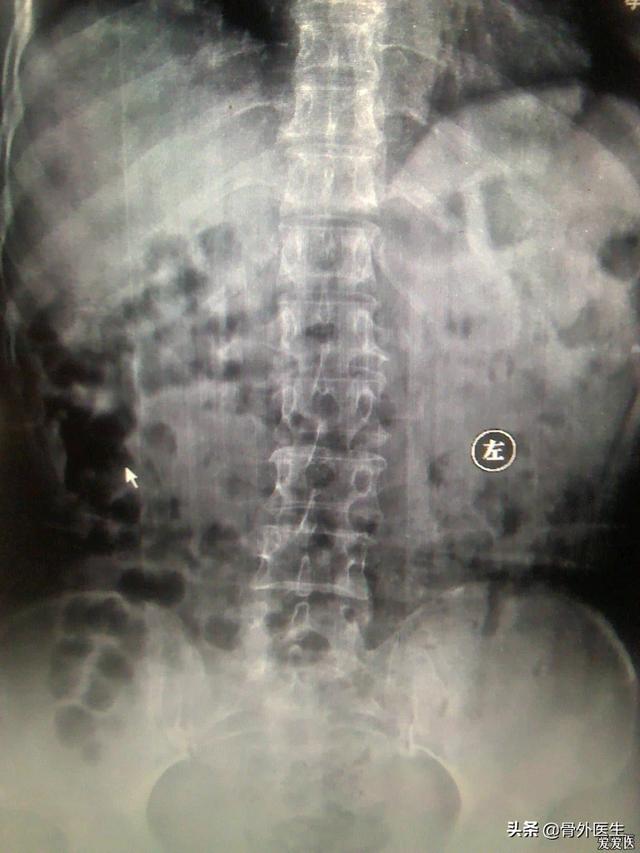 腰椎骨折治疗方法:腰椎骨折怎样治疗最好 外伤腰椎压缩骨折有三分之一多是保守治疗还是手术好？