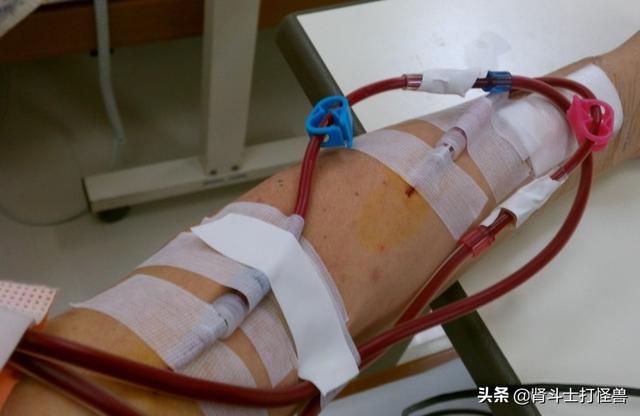 头条问答 - 血透析要在手臂将动脉接上静脉是什么意思?