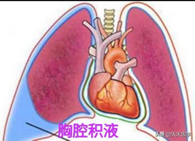 老年人胸腔积液病因有哪些，胸腔积液的分类有哪些胸腔积液和肺积液有什么关系吗