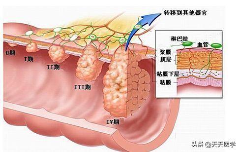 什麼是腸道癌