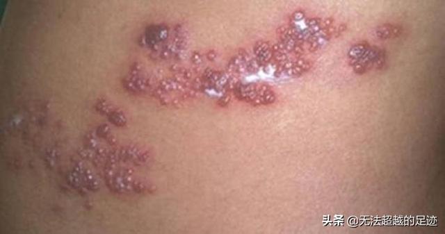 中国民间的怪病"缠腰龙",缠一圈真的会死人吗?-艾薇档案社