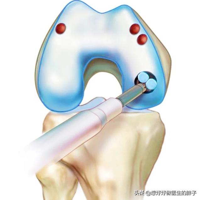 膝盖软骨磨损吃什么号:膝关节软骨磨损了能复原吗？怎么办？