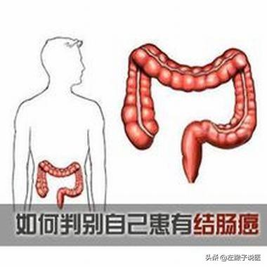 非感染性腹泻可见于:能不能从大便上判断出一个人是否患有结肠癌？