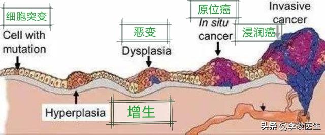 原位癌、微浸润癌、浸润癌有什么区别？