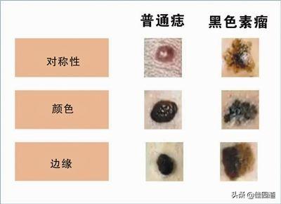 皮肤黑素瘤症状:皮肤恶性黑素瘤 黑色素瘤一般潜伏期多久？有何症状？