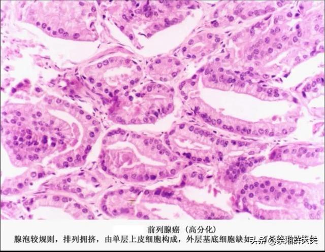 药物去势:药物去势是什么意思 前列癌内分泌治疗多久复查？