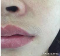 女生嘴边长小胡子应该怎么办？