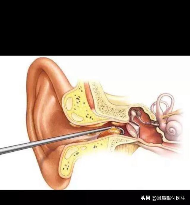 耳屎堵住耳朵自救方法,孩子耳朵里有耳屎堵塞可以掏一掏吗