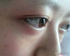 甲状腺机能亢进病:甲状腺功能亢进症危害有多大？
