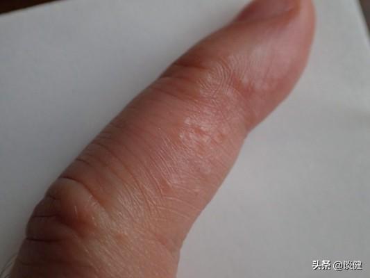 头条问答 - 手上长小水泡很痒是什么原因?(小果脯0929的回答,0赞)