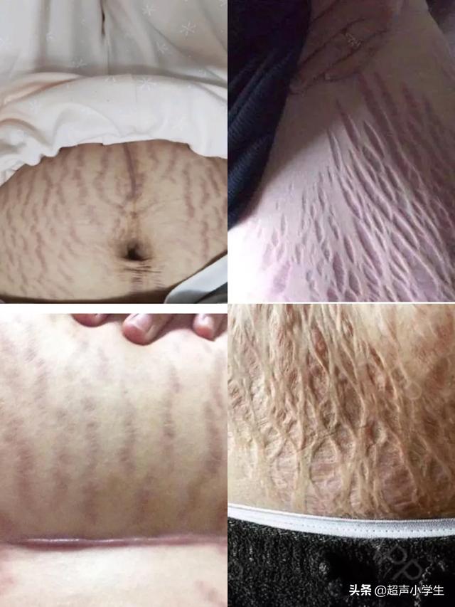 怀孕多久会长妊娠纹？为什么会长妊娠纹？插图11