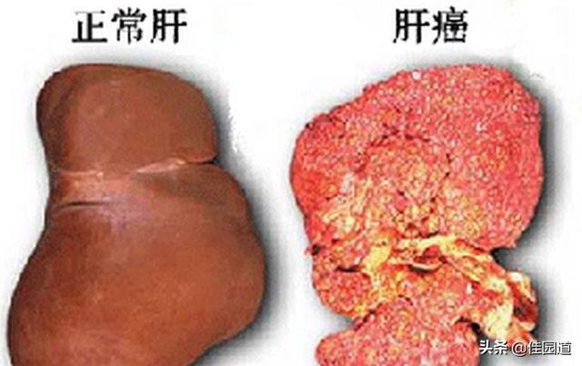 狗狗黑色素瘤早期症状图片:有人说肝癌早期身体会发出3大信号，是指什么？还能挽救吗？