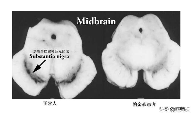 莱姆病症状早期以:帕金森综合症早期症状有哪些？