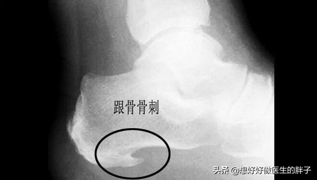 跑步尾巴根疼:朋友不能跑步，一跑步脚后跟就疼，快走也疼，请问这是怎么回事？