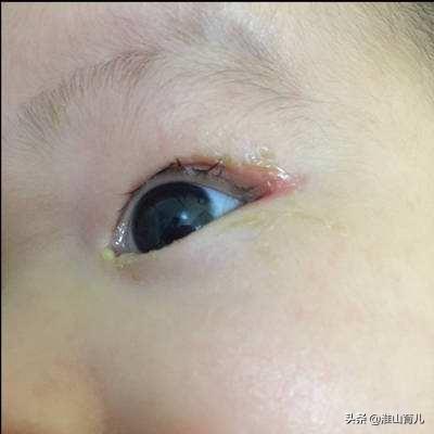 新生儿角膜炎症状图片:新生儿右眼不通，老长眼屎，该如何护理？