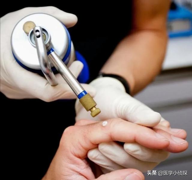 疣状表皮发育不良:女子打过hpv疫苗，6年后却查出宫颈癌，疫苗不管用吗，为何？