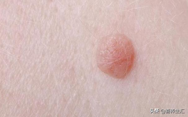 头条问答 - 感染了hpv病毒后,要怎么预防宫颈癌?(18个回答)