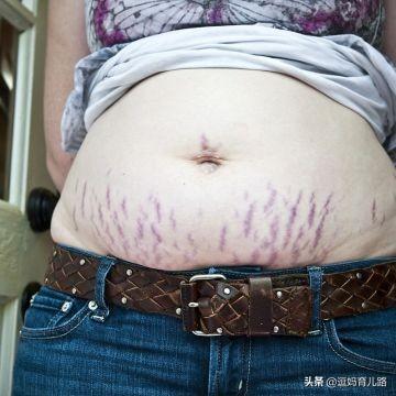 怀孕多久会长妊娠纹？为什么会长妊娠纹？插图44