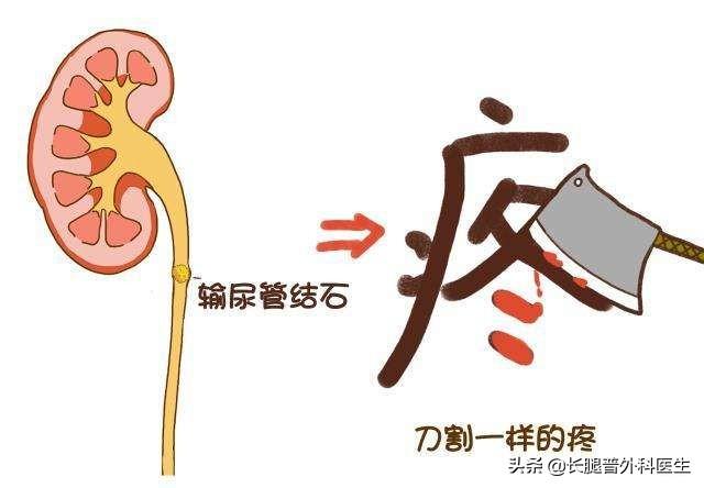 老人尿结石治疗方法:尿结石有什么症状？如何应对？