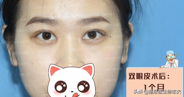 古巨基割双眼皮:长期贴双眼皮贴最后都会走上割双眼皮的路吗