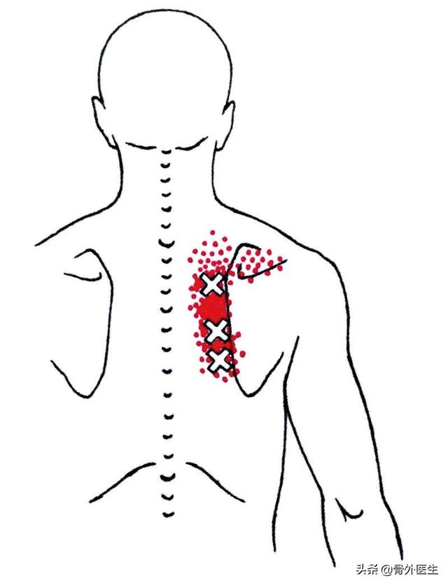 头条问答 - 背部筋硬条圆状,筋疙瘩怎么解决?按摩针灸没用?(31个回答)
