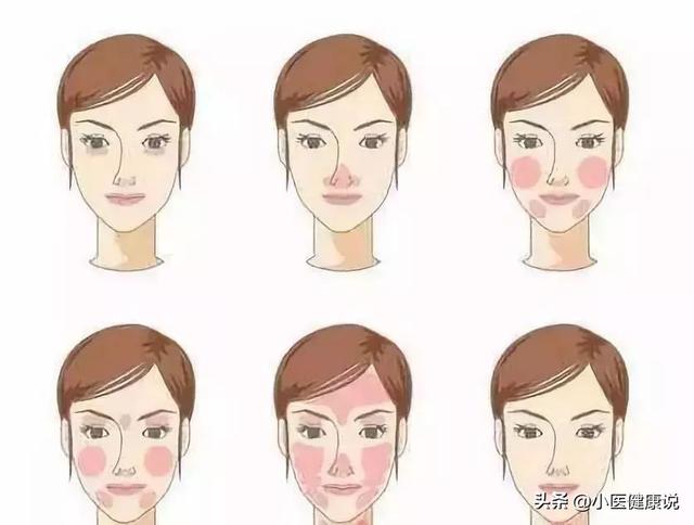 脸部有红血丝:脸部有红血丝用什么化妆品 脸部红血丝是什么原因？是病吗？