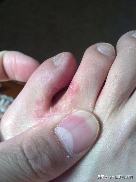 头条问答 - 脚趾缝里长硬疙瘩怎么办?(11个回答)
