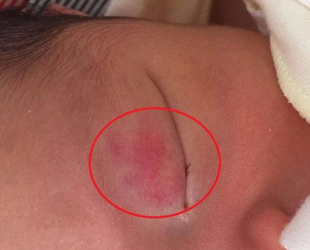 有胎记的孩子是什么投胎来的孩子身上为什么有红胎记是遗传的吗