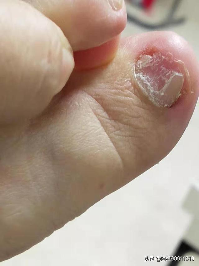 头条问答 - 请问大脚趾甲空了一部分是怎么回事?不疼不痒的?(1个回答)